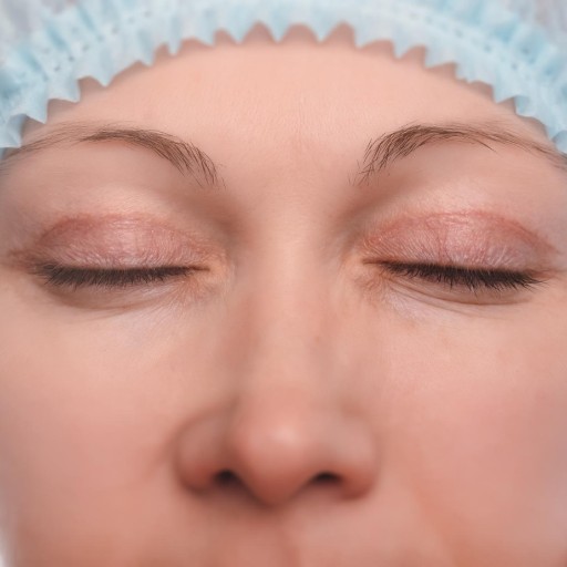 Face Lift (Rhytidectomy) Surgery