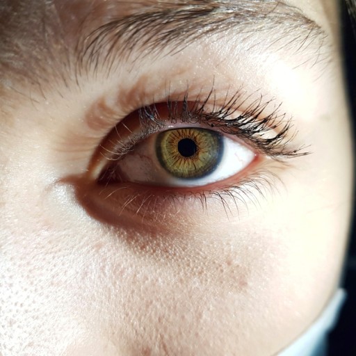 Vitrectomy (One Eye)
